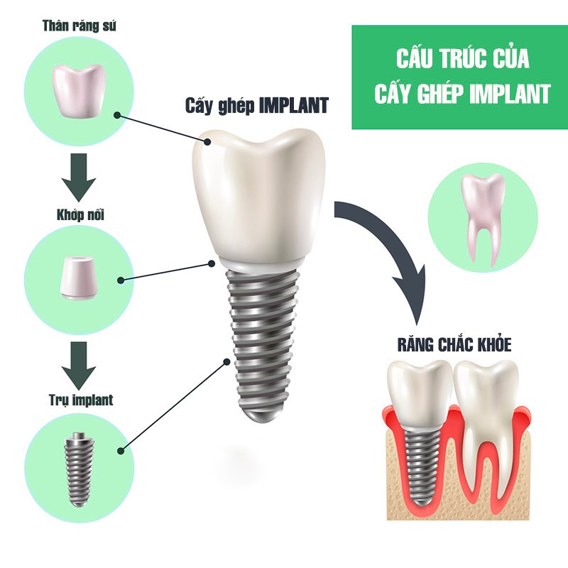 Những điều bạn cần biết về kỹ thuật cấy ghép Implant